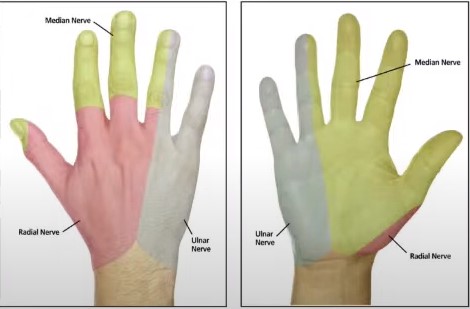кубітальна невропатія, порушення чутливості долонної та тильної поверхні чисти з боку четвертого та п'ятого пальців та самих пальців.
