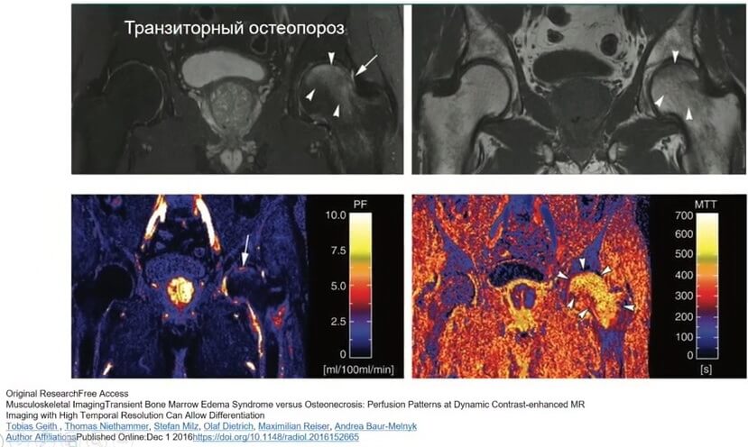 МРТ – транзиторный остеопороз бедренной кости