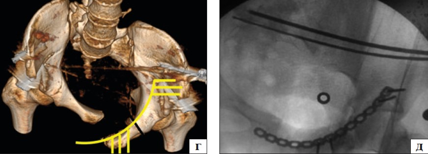 Рис. 4. 3D-планування пересічення симфізу та остеотомії лобкової кістки (червоні лінії) по місцю неправильного зрощення (а), репозиції лобкової кістки в анатомічне положення (б) та зображення її під ЕОП (в); 3D-планування (г) та зображення під ЕОП (д) репозиції лобкової кістки в анатомічне положення та остаточної фіксації пластиною та гвинтами (жовті лінії)