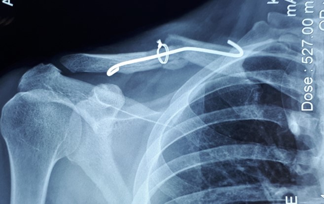 Відсутність рентгенологічної динаміки впродовж 18 місяців – формування хибного суглоба правої ключиці