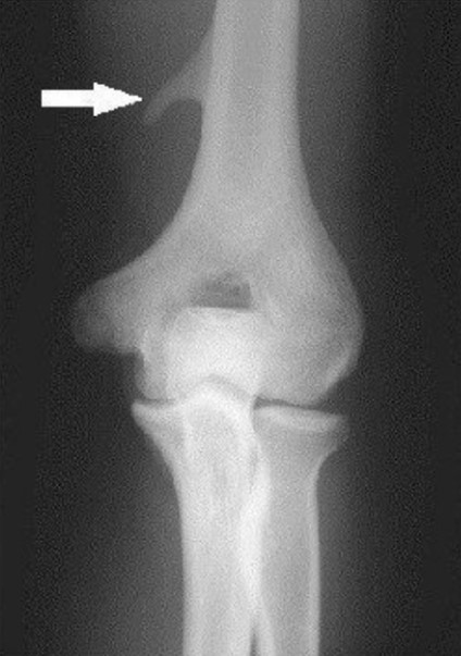 Рентгенологічне дослідження при компресії супракондилярного відростка плеча