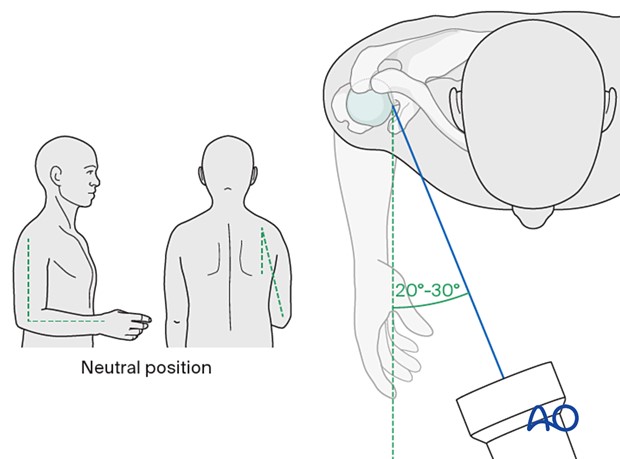 Інтраопераційна візуалізація проксимального відділу плеча 