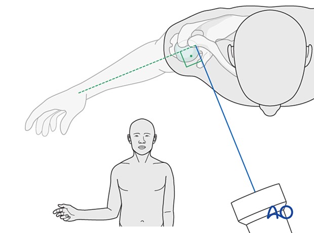 Інтраопераційна візуалізація проксимального відділу плеча 