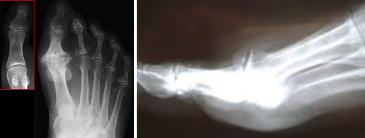 Hallux Rigidus - (тугорухливість першого плюснефалангового суглоба великого пальця стопи, hallux limitus, деформуючий остеоартроз) Причини, симптоми, діагностика, лікування та реабілітація, профілактика та прогноз