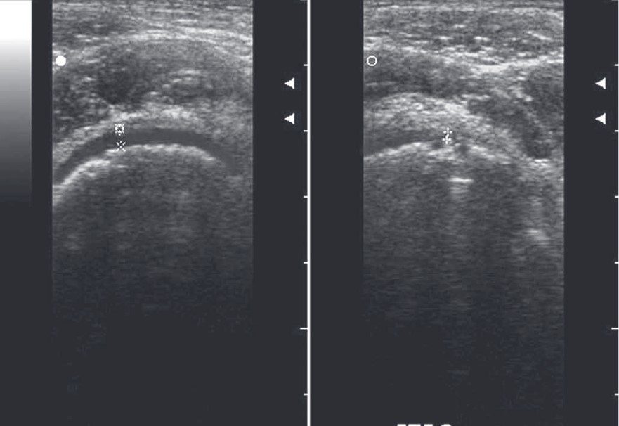 Рис. 7. Гонартроз, 3-я стадія. Візуалізується значне витончення гіалінового хряща зліва, субхондральні кісти та виражений синовіт з обох боків.
