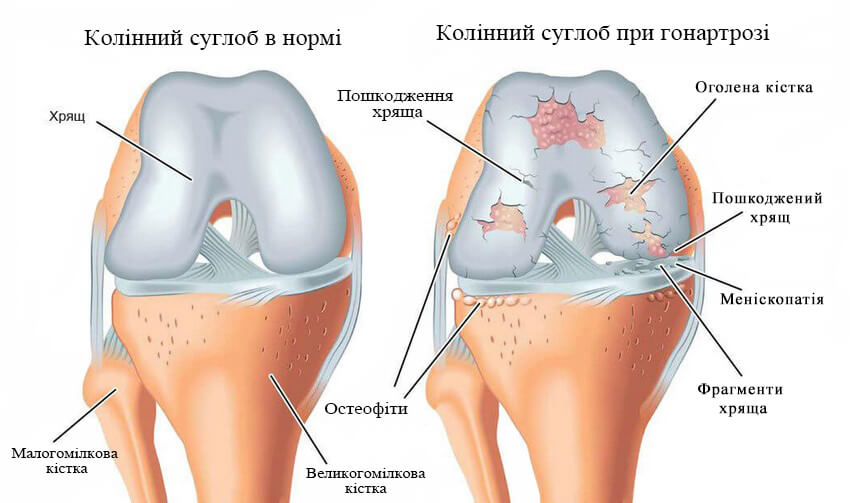Колінний суглоб (без надколінка) у нормі та на різних стадіях гонартрозу