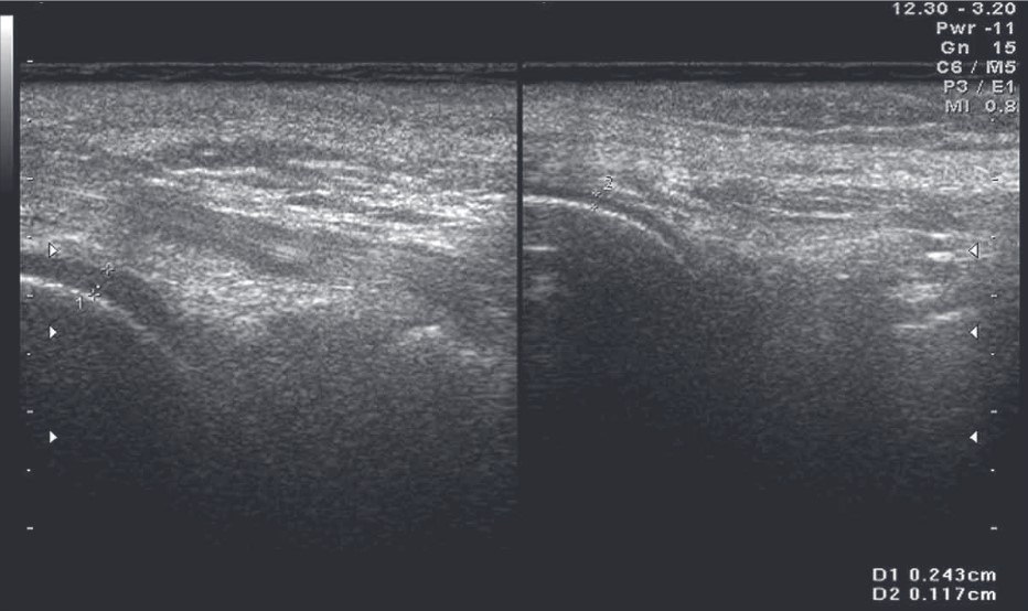 Рис. 2. Нерівномірне зниження товщини гіалінового хряща лівого колінного суглоба при поздовжньому скануванні із заднього доступу