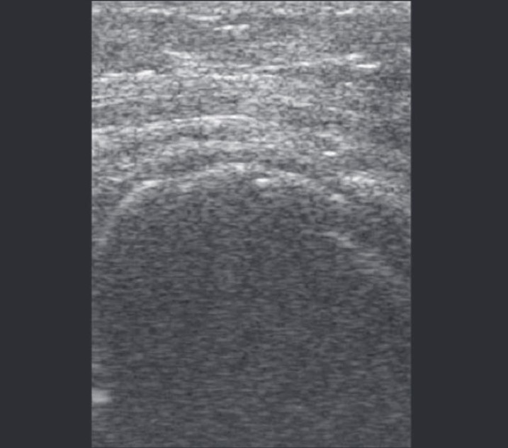 Рис. 4. Нерівномірне зниження товщини гіалінового хряща правого колінного суглоба та утворення дрібних крайових остеофітів.