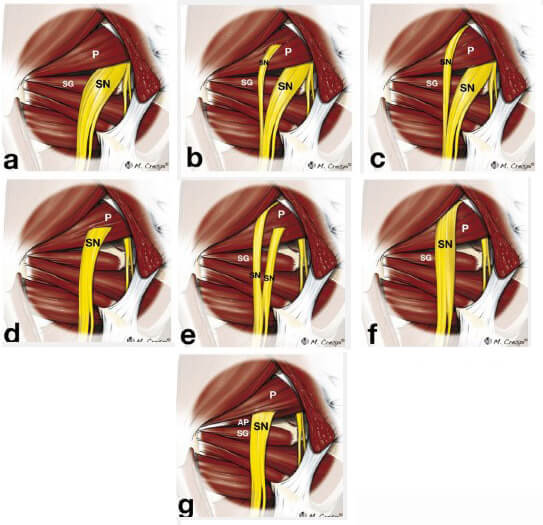 Анатомічні варіації взаємозв’язку розташування грушоподібного м’яза та сідничного нерва (a-f) Діаграми ілюструють шість варіантів, описаних Бітоном та Енсоном (1938).