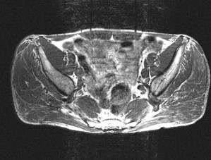 Ознаки синдрому грушоподібного м'яза на МРТ