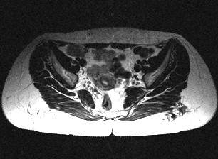 Пацієнт з підгрушоподібною сідничною нейропатією зліва. Магнітно-резонансна томографія сідничної сфери. Грушоподібний м'яз зліва потовщений, структура, контури неоднорідні