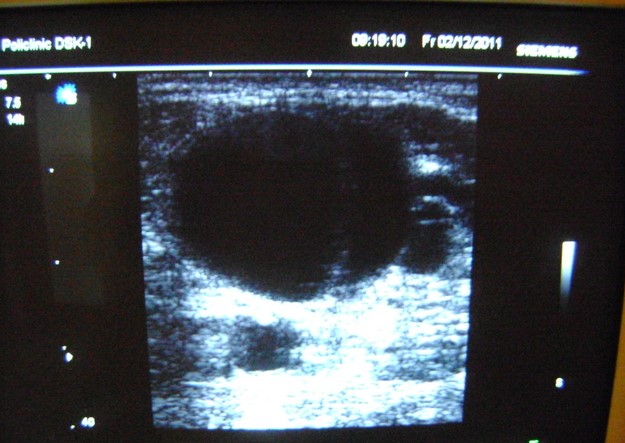 Діагностика кісти Бейкера. Чорна пляма з каналом, що відходить у порожнину суглоба, на фото і є кіста Бейкера.