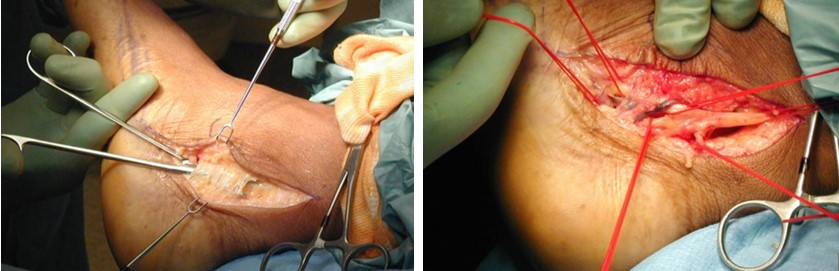 Інтраопераційна фотографія - хірургічне розсічення утримувача згиначів, що оголює великогомілковий нерв у тарзальному каналі