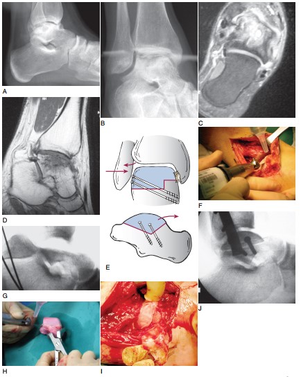 Алопластика дефекту таранної кістки – етапи проведення операції (приклад)