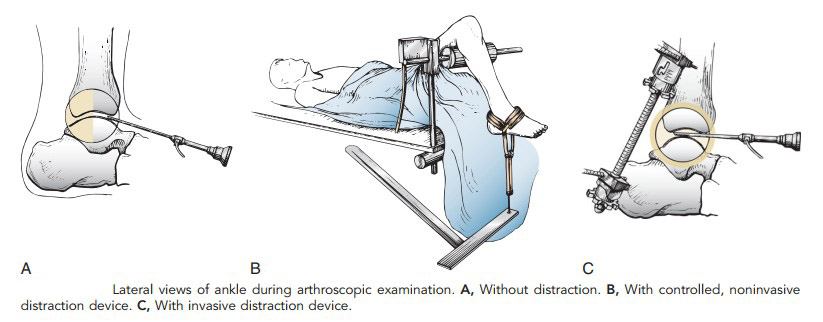 Особливості проведення артроскопічних операцій на гомілковостопному суглобі (схематично)…