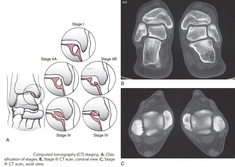 Трансхондральні пошкодження таранної кістки (схематично) та візуалізація на КТ