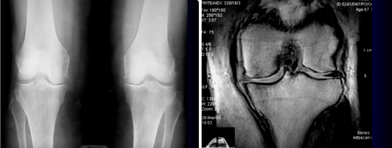 2-3 стадия остеоартрита. На рентгеновском снимке (слева) четко виды: неравномерное сужение суставной щели и остеофиты. На МРТ (справа): неравномерное сужение суставной щели в медиальном отделе, значительные изменения медиального мениска, коллатеральная связка неравномерно отходит от края кости