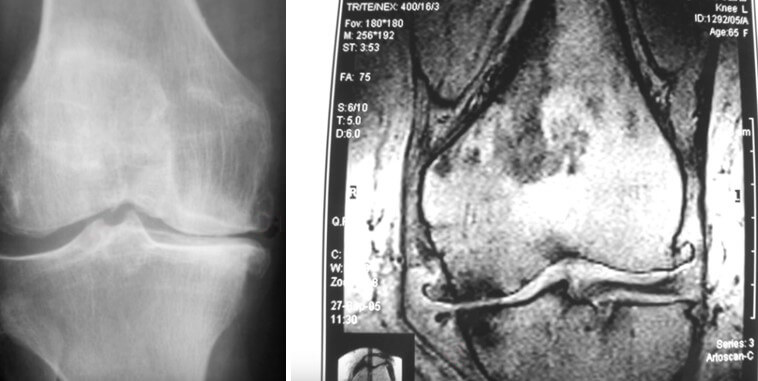 Рентгенологічна класифікація та діагностика остеоартриту. Чи потрібна допомога МРТ?