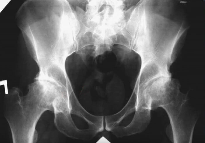 Асептические некрозы головок бедренных костей с последующим развитием всех признаков ОА (на фото рентгенограмма пациентка с системной красной волчанкой, которая длительное время лечится глюкокортикоидами 