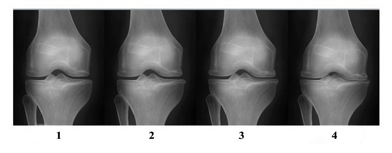 Несколько слов о рентгенологических стадиях остеоартроза по J. Kellgren & J. Lawrence, принятых в далеком 1957 году, о них мы подробно писали в материале «Гонартроз - деформирующий артроз коленного сустава»