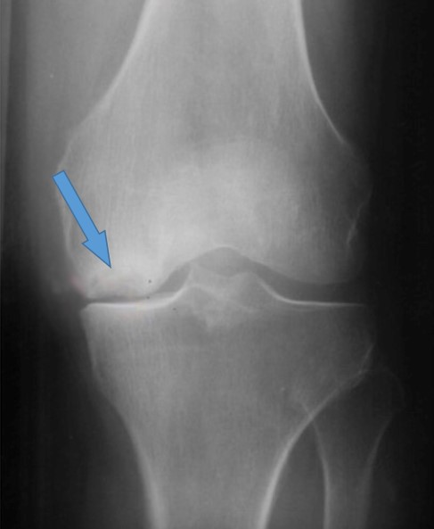 Как неоднократно писалось, ОА могут осложняться другими патологическими состояниями, например, асептическим некрозом, болезнь Кенига (остеохондрит мыщелка бедренной кости коленного сустава)