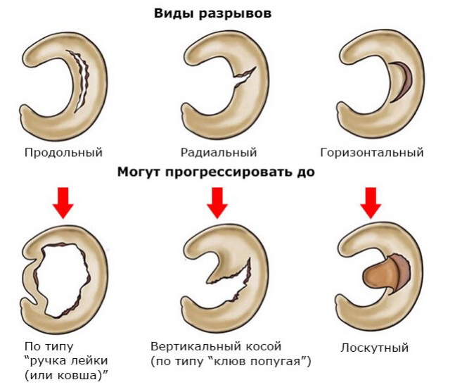 Виды повреждений менисков