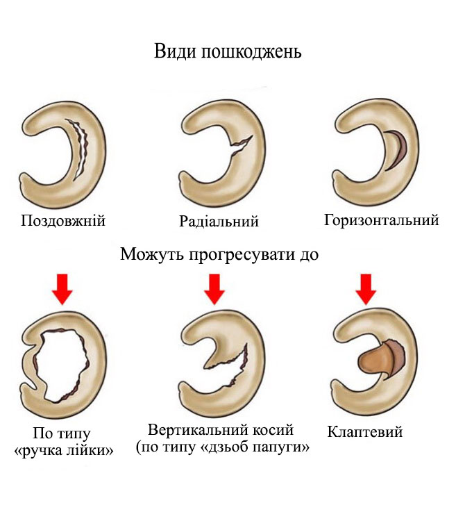 Види пошкоджень менісків