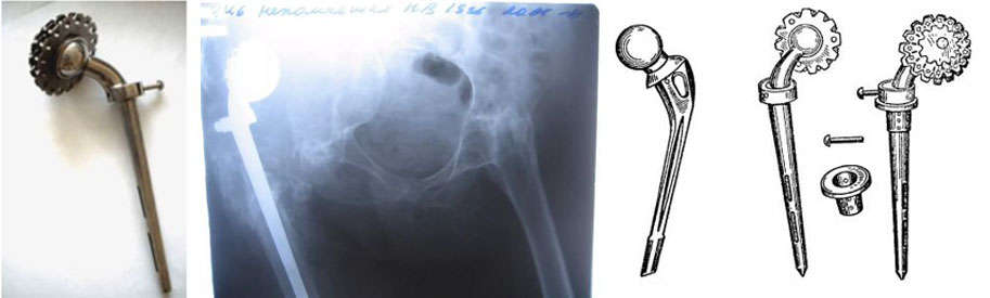 Тотальний ендопротез кульшового суглоба, доктора К. М. Сиваша