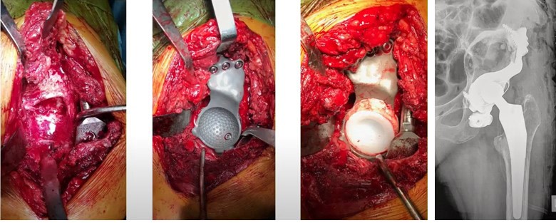 Результат – виконано ревізійне ендопротезування лівого кульшового суглоба – встановлено індивідуальний вертлужний компонент