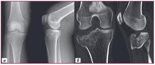 Рисунок 1. Рентгенограми і КТ пацієнта Д. (Schatzker II): а) рентгенограми (внутрішньосуглобовий перелом латерального виростка правої великогомілкової кістки зі зміщенням уламків); б) КТ (багатоуламковий характер перелому з імпресією передньолатерального відділу латерального виростка)