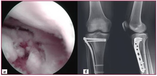 Рисунок 2. Артроскопічна візуалізація внутрішньосуглобових ушкоджень і післяопераційні рентгенограми: а) артроскопічна візуалізація — радіальне ушкодження латерального меніска з імпресією суглобової поверхні; б) післяопераційні рентгенограми