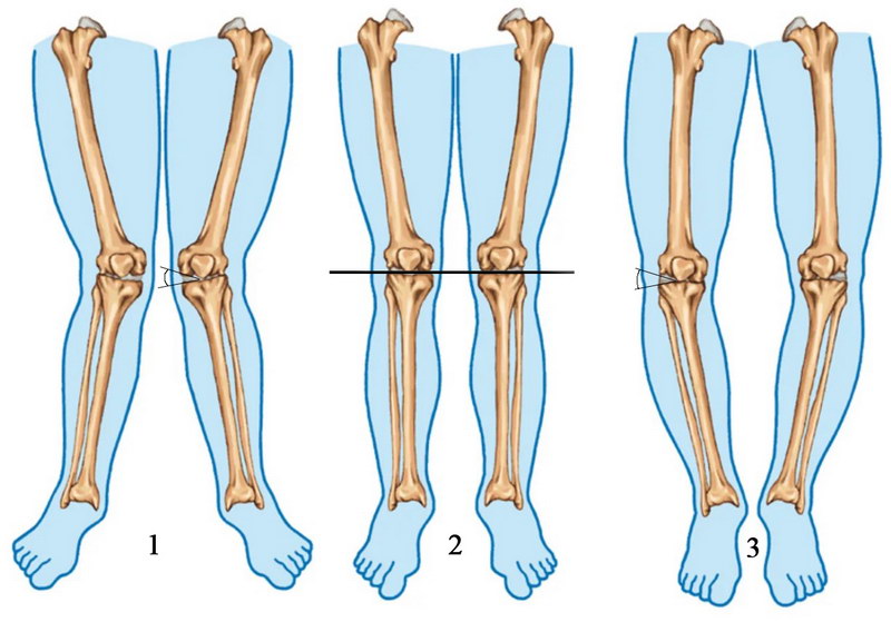 1. Вальгусна деформація – кут деформації відкритий всередину 2. Норма 3. Варусна деформація – кут деформації відкритий дозовні.