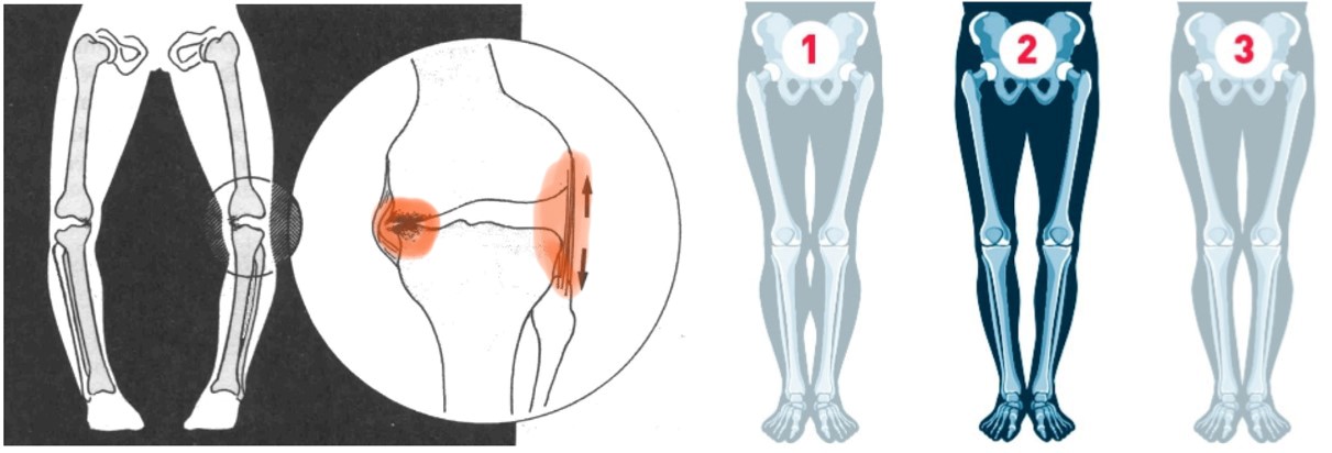 Зони ризику в колінному суглобі при варусній деформації (ліворуч) 1. Фізіологічна норма  2. Справжня (істинна) варусна деформація 3. НЕсправжня варусна деформація ніг