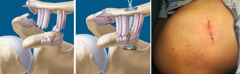 Фіксація ключиці за методикою MINAR (minimally invasive acromioclavicular reconstruction). Праворуч – рана після накладання швів (3 см).