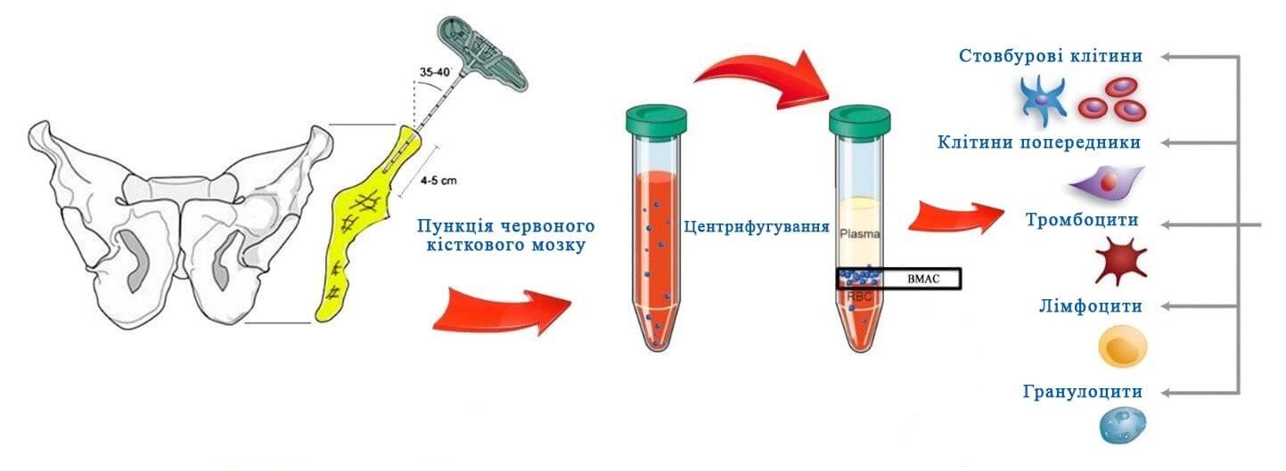 N.B. Тунелізація (декомпресія) з подальшим введенням в місце патології стовбурових клітин є найчастіше виконуваною процедурою в світі. Декомпресія технічно проста процедура та не вимагає наявності дорогого специфічного обладнання.