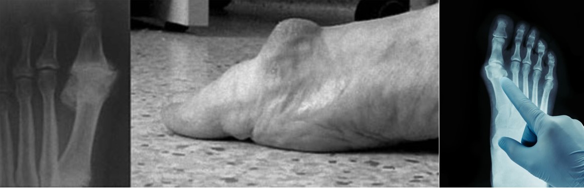 Симптоми та діагностика Hallux rigidus