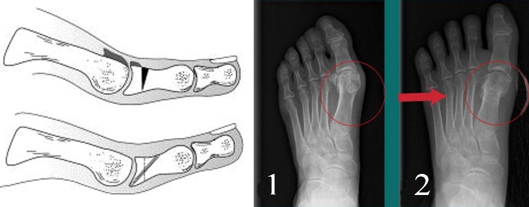 Тильна клиноподібна остеотомія основної фаланги першого пальця або операція Моберга при Hallux Rigidus (ліворуч). Коригувальна вкорочуюча остеотомія, виконана черезшкірним методом (праворуч)