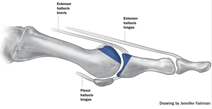 Резекційна артропластика або операція Келлера при лікуванні ригідного першого пальця стопи
