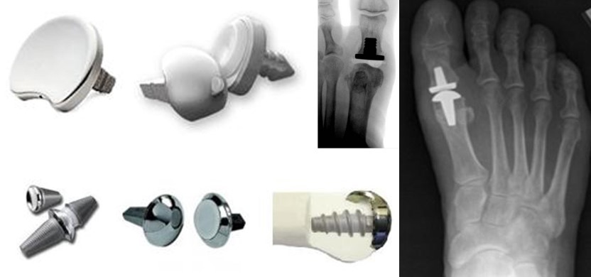 Деякі представники сучасних імплантатів, що використовуються для артропластики (ендопротезування) першого плюснефалангового суглоба при Hallux Rigidus