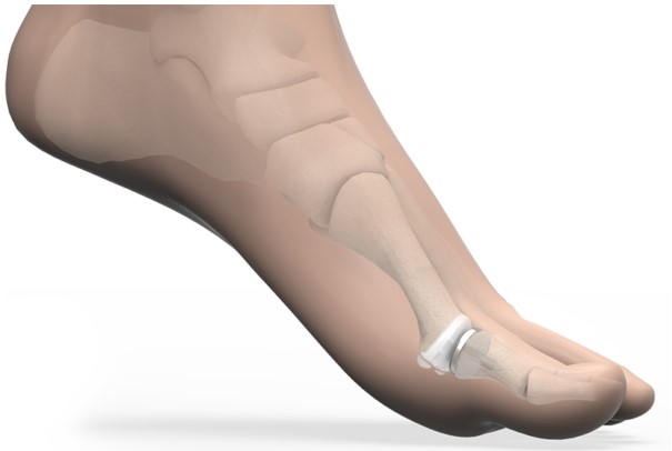 Варіант ендопротезування від BioPro MPJ Hemi замінює суглобовий хрящ з одного боку суглоба (проксимальна фаланга) гладким та міцним імплантатом. Усуваючи контакт кістки з кісткою, імплантат забезпечує знеболення та відновлення рухів. Конструкція запобігає впливу на імплантат високих сил, до 119% ваги тіла, що діють на головку плеснової кістки під час ходьби.