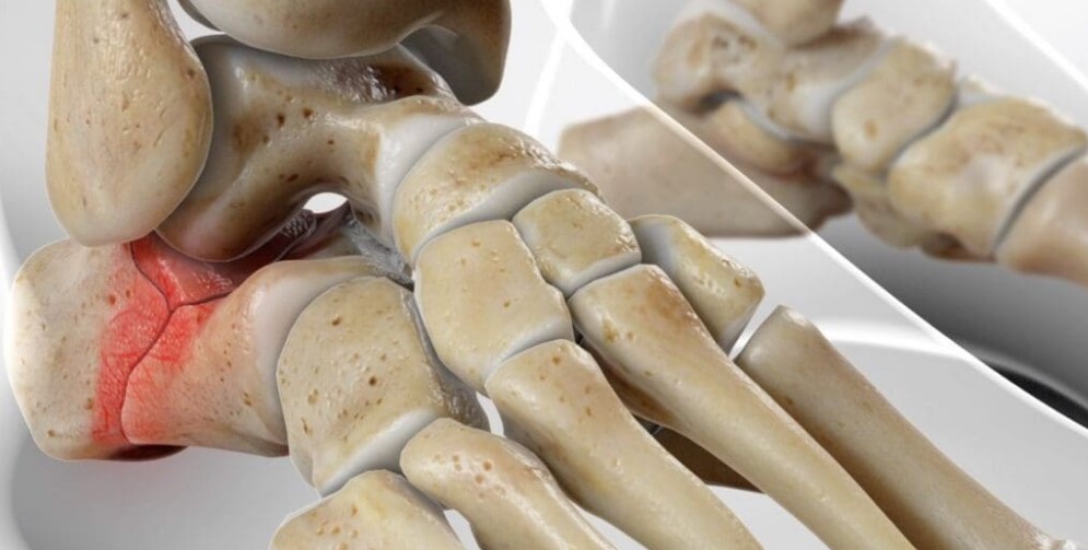 Переломи пʼяткової кістки: коли опора стопи потребує відновлення