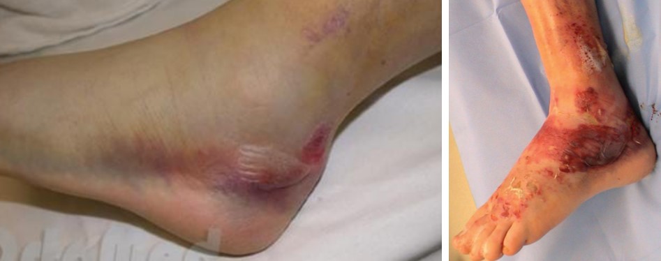 Переломи пʼяткової кістки: коли опора стопи потребує відновлення