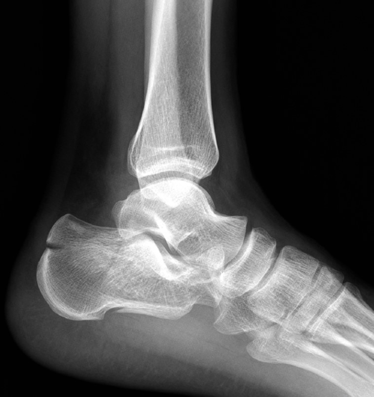 Переломи пʼяткової кістки: коли опора стопи потребує відновлення