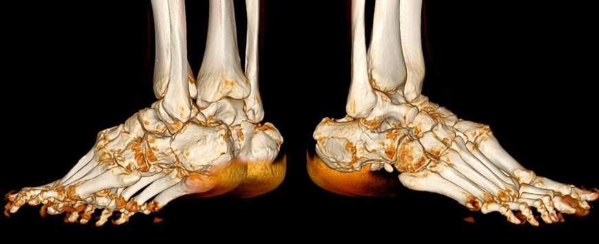 Переломи пʼяткової кістки: коли опора стопи потребує відновлення