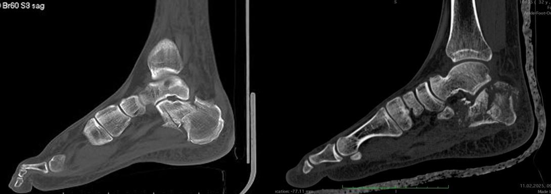 Переломи пʼяткової кістки: коли опора стопи потребує відновлення
