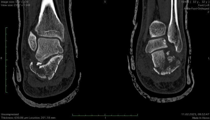 Переломи пʼяткової кістки: коли опора стопи потребує відновлення