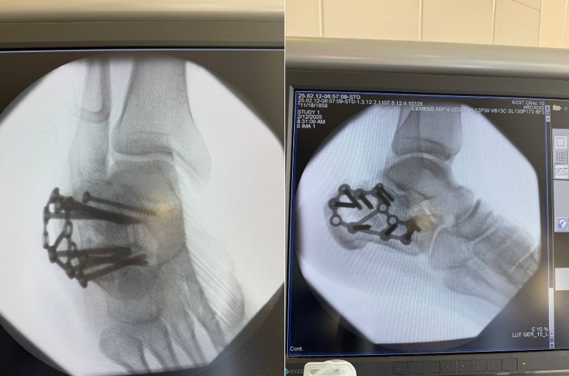 Переломи пʼяткової кістки: коли опора стопи потребує відновлення