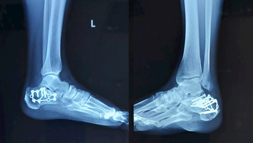 Переломи пʼяткової кістки: коли опора стопи потребує відновлення