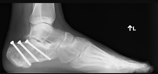 Переломи пʼяткової кістки: коли опора стопи потребує відновлення