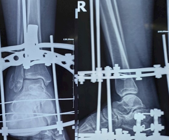 Переломи пʼяткової кістки: коли опора стопи потребує відновлення